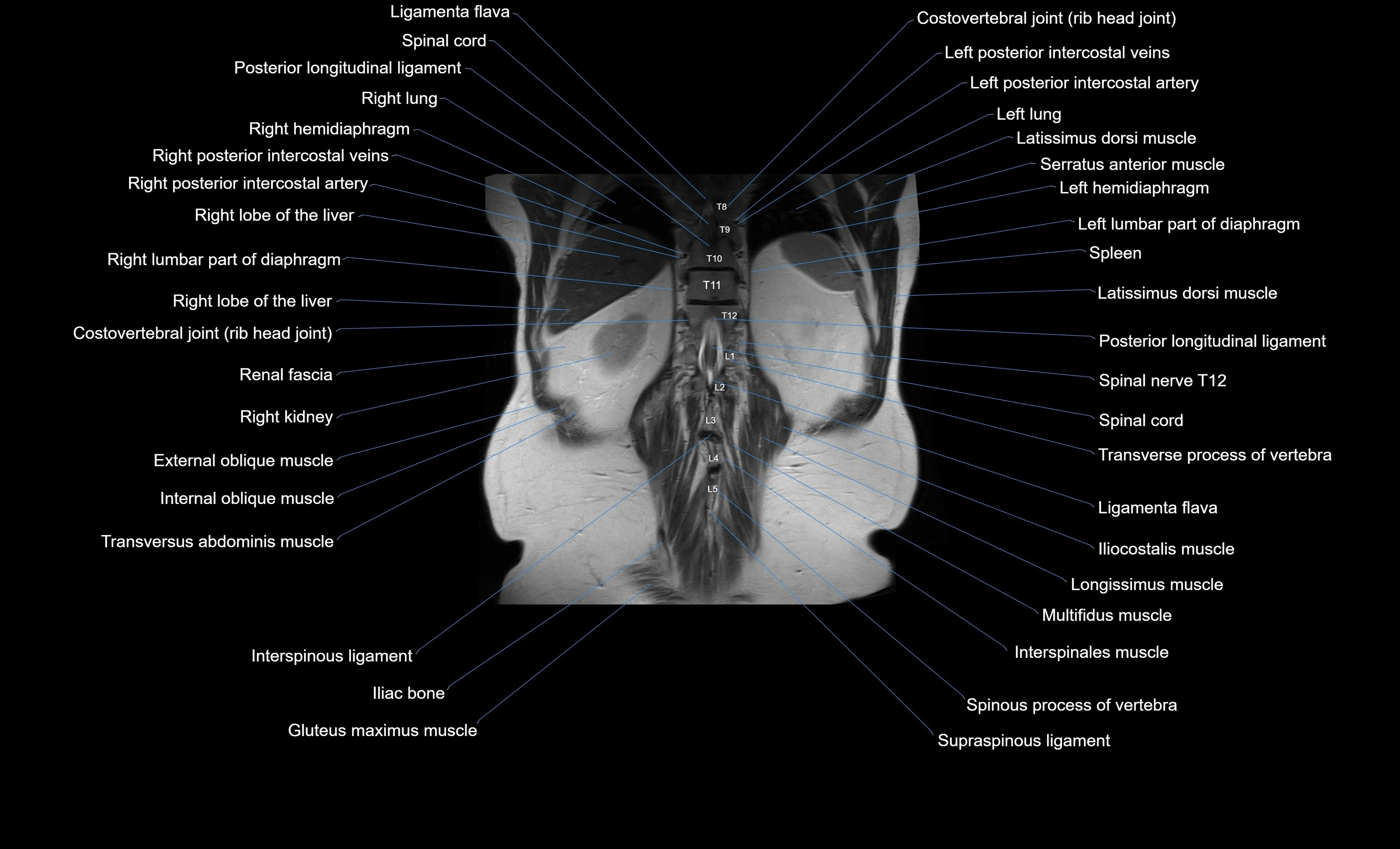 MRI Abdomen coronal labelled cross sectional anatomy radiology  image-img-00001-00048.webp
